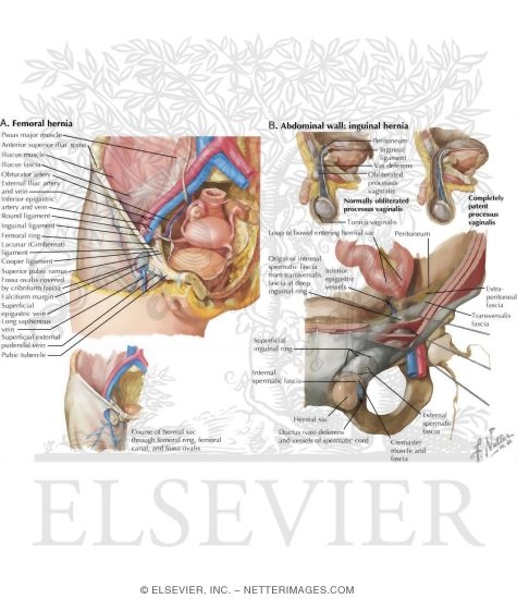 Watermarked preview of labeled image: Hernias
