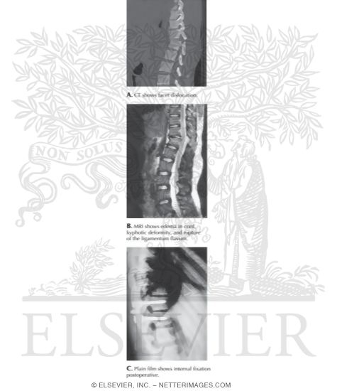 Watermarked preview of labeled image: Fracture Dislocation of T11 On T12