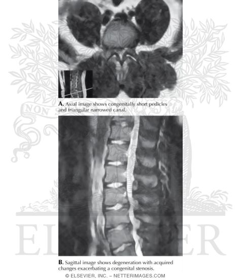 Watermarked preview of labeled image: Spinal Stenosis