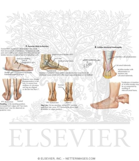 Watermarked preview of labeled image: Tendon Problems Around the Ankle