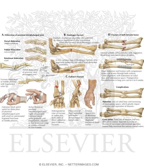Upper Extremity Fractures and Dislocations