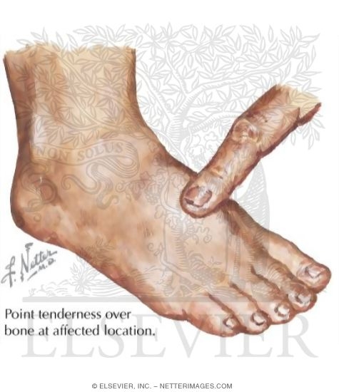 Physical Examination of Stress Fracture