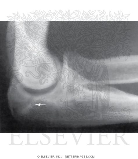 Lateral Elbow, Olecranon Stress Fracture
