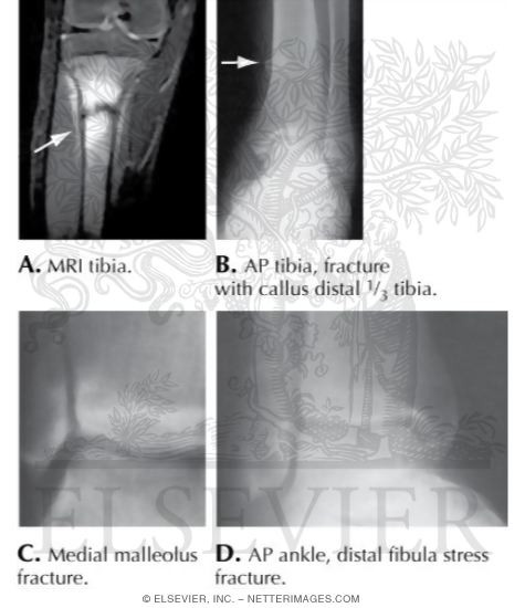 Watermarked preview of labeled image: Knee and Lower Leg Stress Fractures