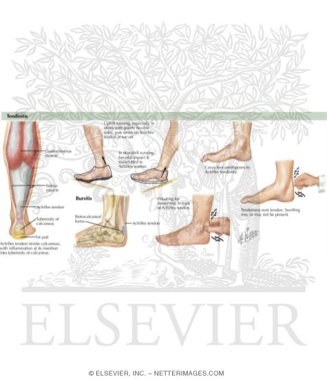 Watermarked preview of labeled image: Achilles Tendinitis and Retrocalcaneal Bursitis
