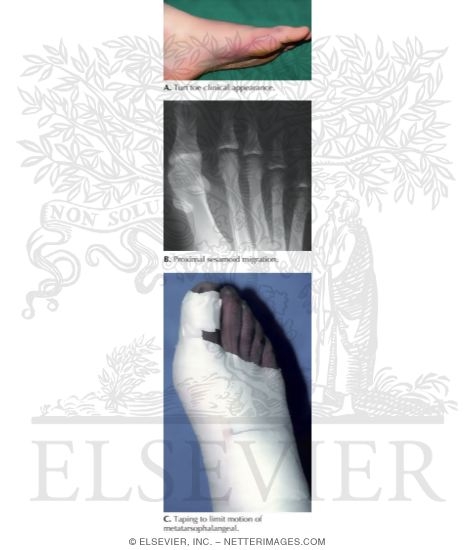 Watermarked preview of labeled image: Turf Toe