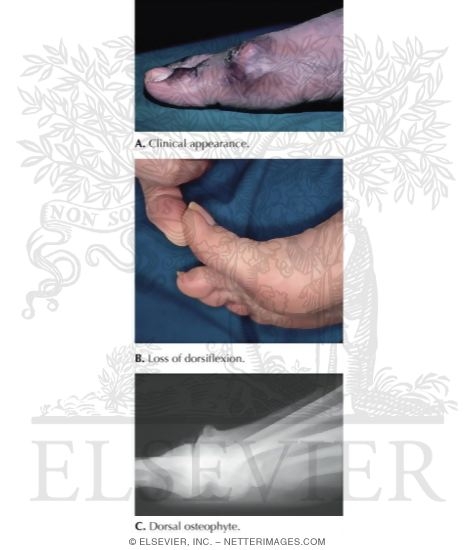 Watermarked preview of labeled image: Hallux Rigidus