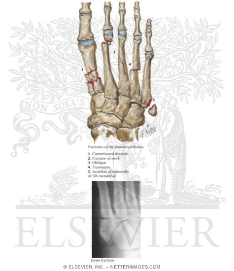 Watermarked preview of labeled image: Metatarsal Fractures