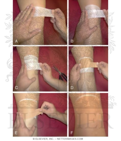 Watermarked preview of labeled image: Taping Procedures: Patellofemoral Taping