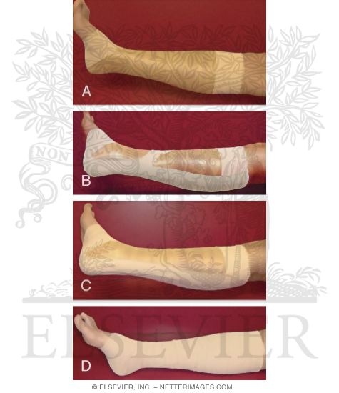 Watermarked preview of labeled image: Taping Procedures: Achilles Tendon Taping