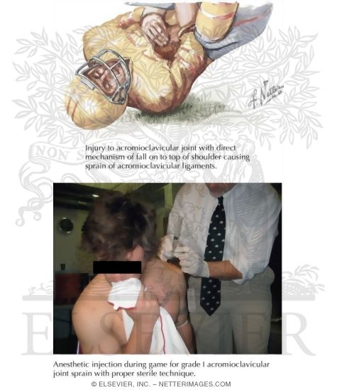 Watermarked preview of labeled image: Acromioclavicular Injury