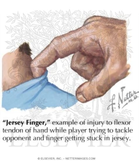 Watermarked preview of labeled image: Jersey Finger