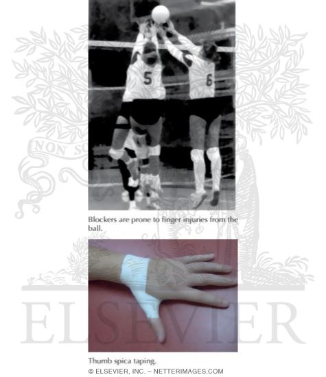 Watermarked preview of labeled image: Finger and Thumb Sprains