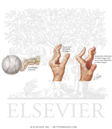 Finger Injuries