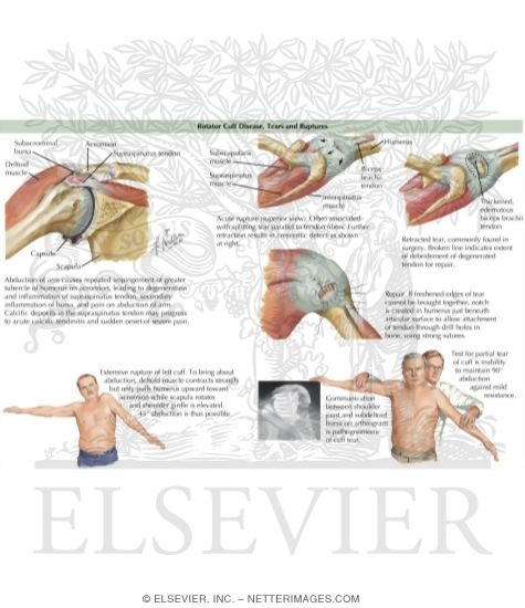 Watermarked preview of labeled image: Rotator Cuff Injuries
