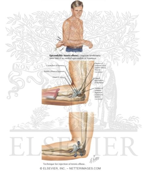 Tennis Elbow