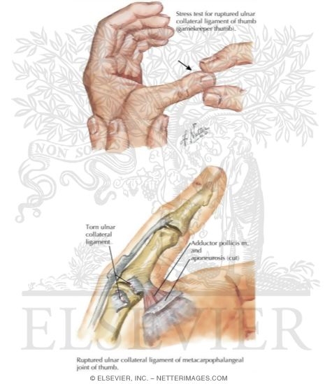 Skier's Thumb