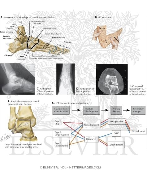 Watermarked preview of labeled image: Fracture of Lateral Process of Talus