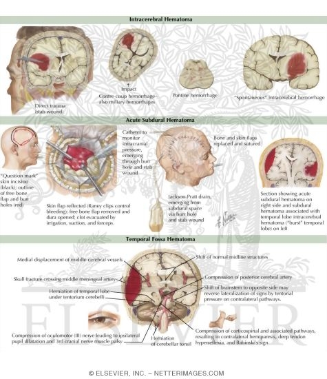 Watermarked preview of labeled image: Acute Traumatic Brain Injury