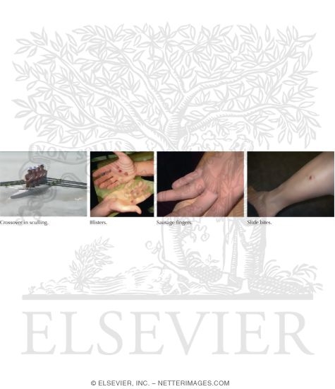 Hand Blisters and Skin Abrasions In Rowing