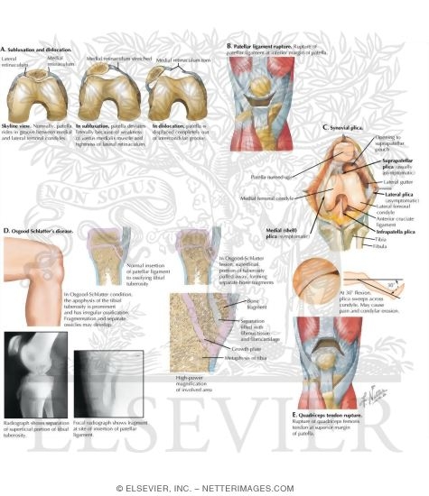 Watermarked preview of labeled image: Extensor Mechanism Problems