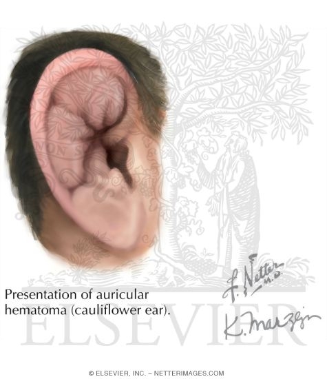 Auricular Hematoma (