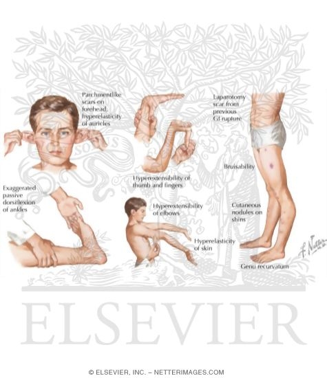 Characteristics of Ehlers-Danlos Syndrome