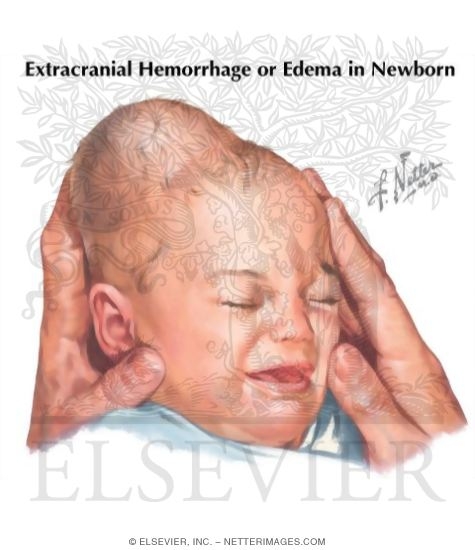 Cerebral Birth Injuries, Cephalhematoma