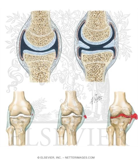 Watermarked preview of unlabeled image: Structure and Degrees of Sprain of the Synovial Joint
