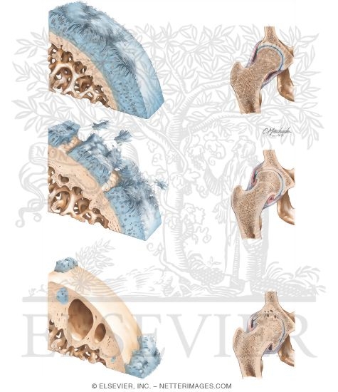 Watermarked preview of unlabeled image: Degenerative Changes In the Hip