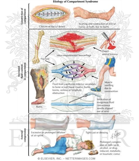 Watermarked preview of labeled image: Etiology of Compartment Syndrome 