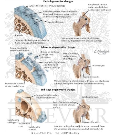 Watermarked preview of labeled image: Degenerative Changes In the Hip