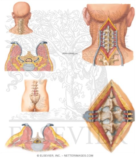Watermarked preview of unlabeled image: Surgical Approaches to the Spine