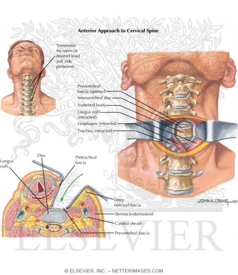 Anterior Approach to Cervical Spine