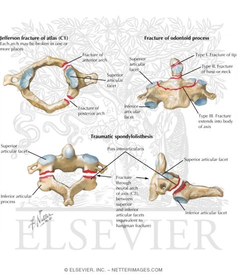 Watermarked preview of labeled image: Trauma of the Spine