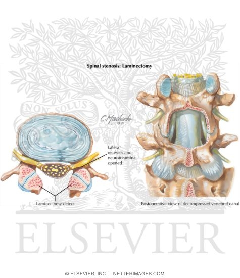 Watermarked preview of labeled image: Spinal Stenosis: Laminectomy