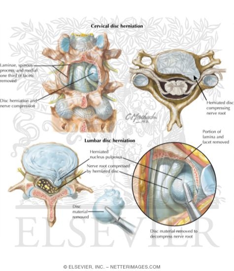 Watermarked preview of labeled image: Disorders of the Spine