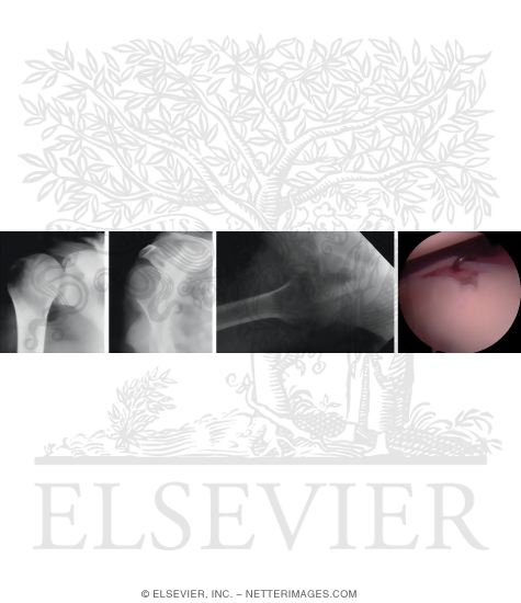Watermarked preview of unlabeled image: Posterior Glenohumeral Instability