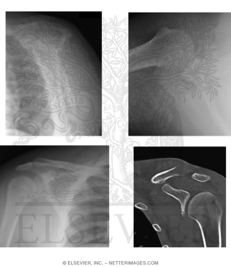 Watermarked preview of unlabeled image: Radiology of the Shoulder