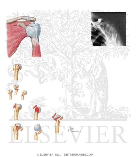 Watermarked preview of unlabeled image: Shoulder Trauma