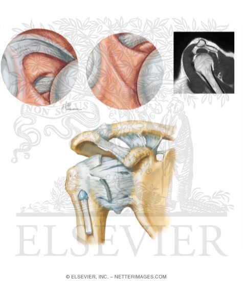 Arthroscopy of the Shoulder