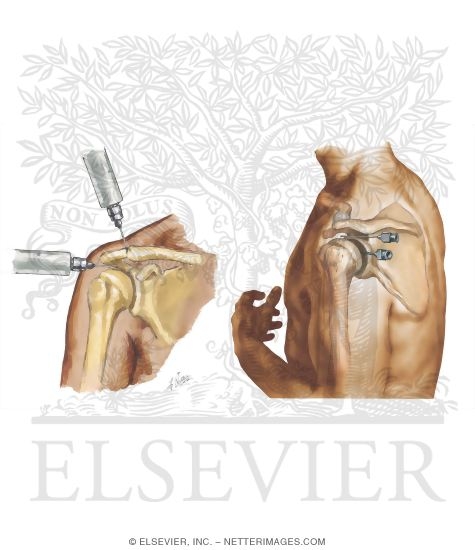Watermarked preview of unlabeled image: Minor Procedures of the Shoulder