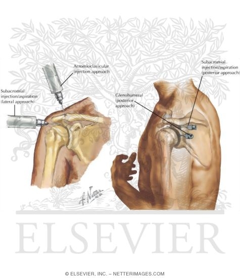 Watermarked preview of labeled image: Minor Procedures of the Shoulder