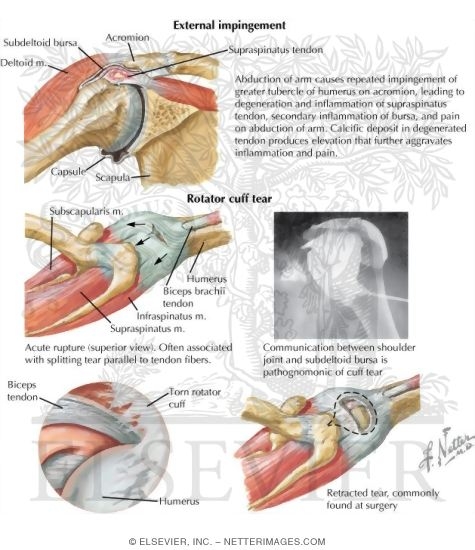 Watermarked preview of labeled image: Disorders of the Shoulder