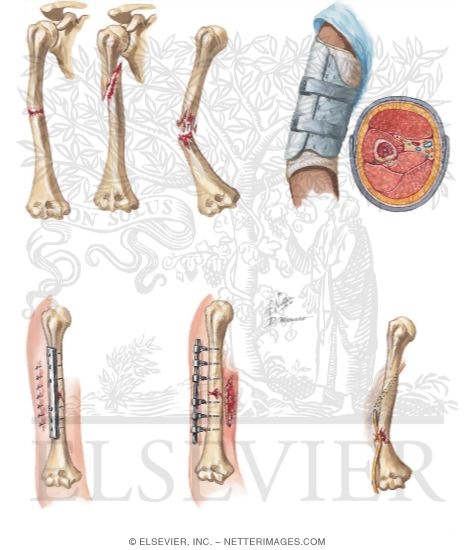 Humeral Shaft Fractures