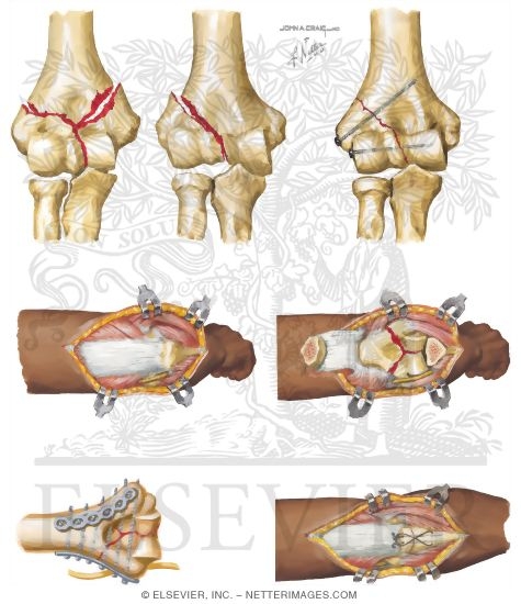 Distal Humerus Fractures