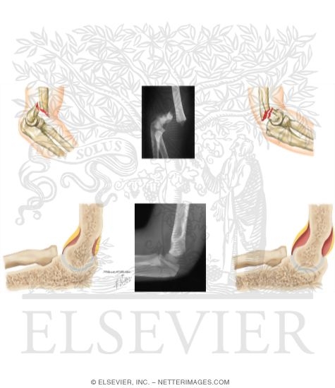 Watermarked preview of unlabeled image: Supracondylar Fracture