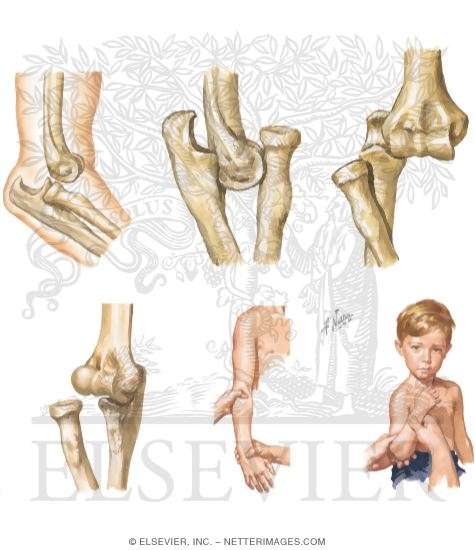 Watermarked preview of unlabeled image: Trauma of the Arm