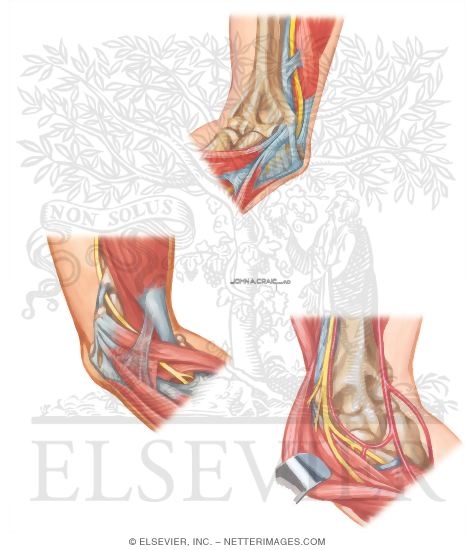 Watermarked preview of unlabeled image: Cubital Tunnel Syndrome: Sites of Compression
