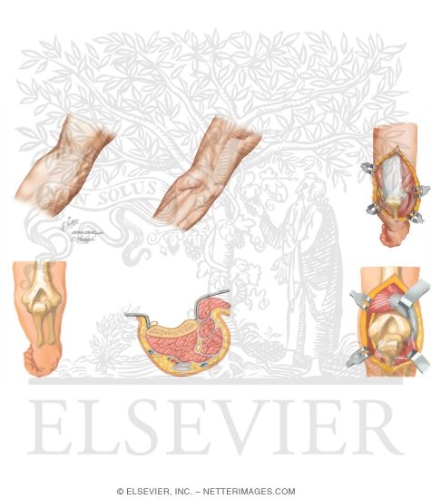 Watermarked preview of unlabeled image: Surgical Approaches to the Upper Arm and Elbow (Continued)